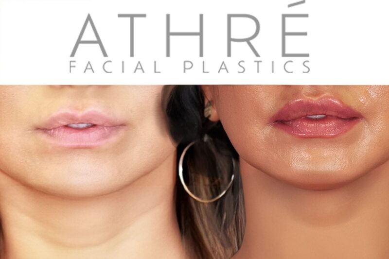 Before and after internal lip lift without external incision by Dr. Raghu Athré.