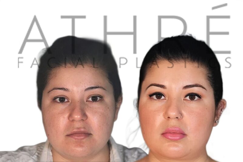 Before and after upper lip lift by Dr. Raghu Athré.
