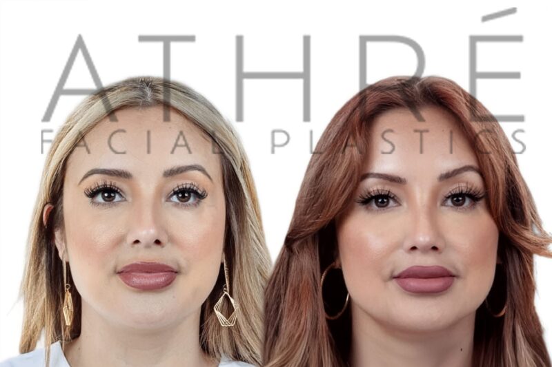 Before and after scarless upper and lower lip lift by Dr. Raghu Athré.