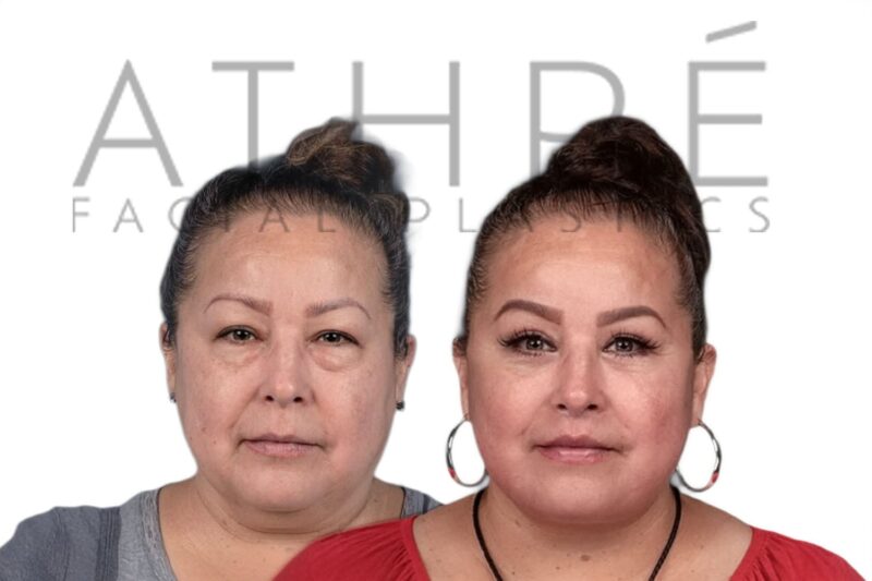 Female patient before and after upper lip lift and facial rejuvenation by Dr. Raghu Athré.