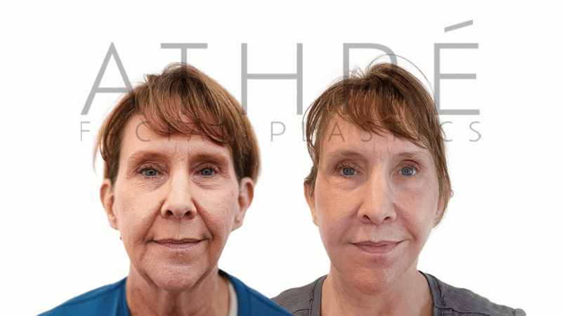 Before and after comprehensive 4D Facelift with lip lifts by Dr. Raghu Athré.
