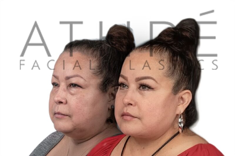 Before and after external upper lip lift by Dr. Raghu Athré.