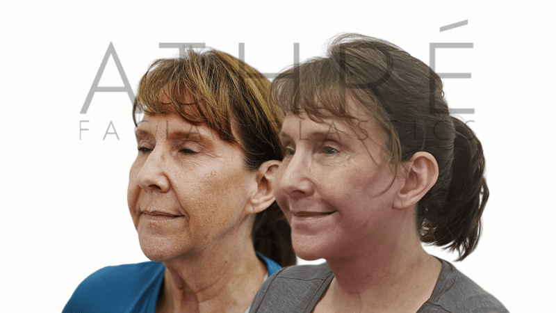 Before and after facial rejuvenation and lip enhancement by Dr. Raghu Athré.