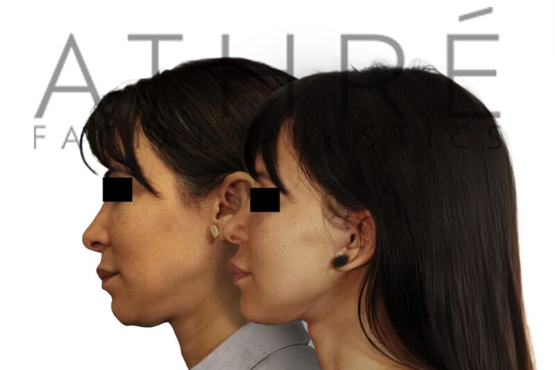 Female patient after subnasal lip lift surgery performed by Dr. Raghu Athré.