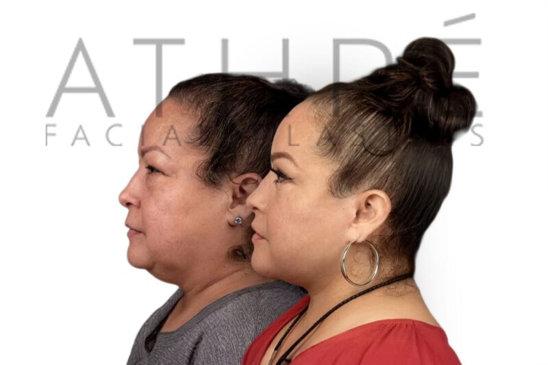 Upper lip lift and facial rejuvenation in female patient by Dr. Raghu Athré