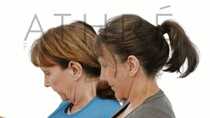 58 year old female before and after 4D Facelift and lip lift surgery by Dr. Raghu Athré.