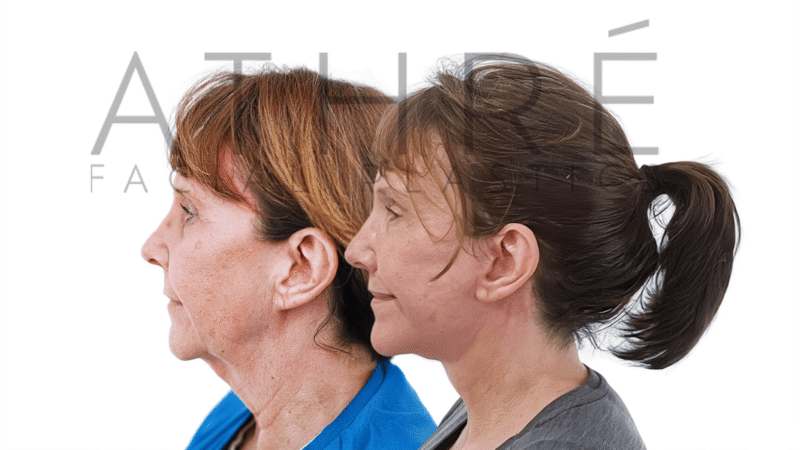 Before and after deep plane facelift and upper lower lip lifts by Dr. Raghu Athré.