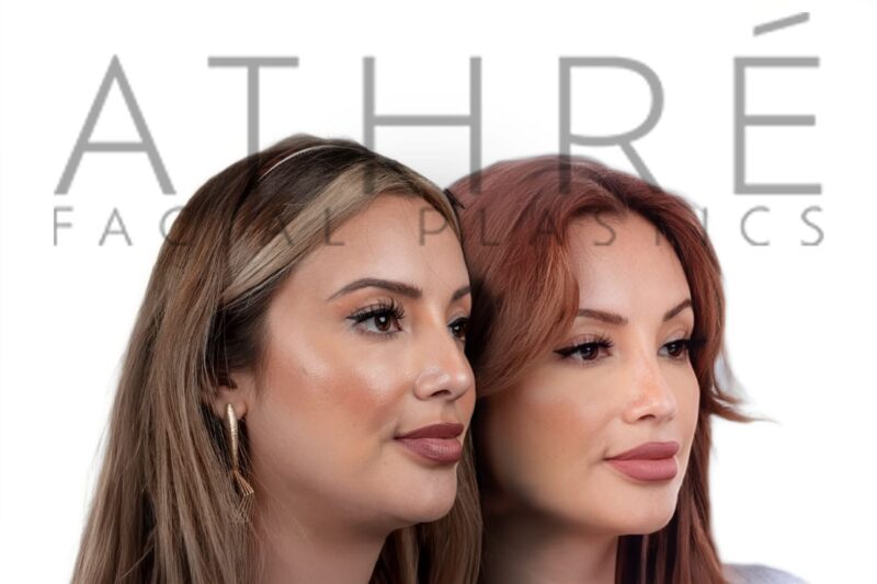 Scarless internal lip lift surgery for upper and lower lips by Dr. Raghu Athré.