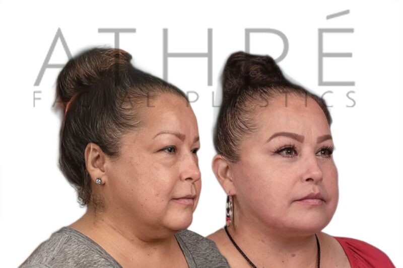 Before and after facial rejuvenation and upper lip lift by Dr. Raghu Athré.
