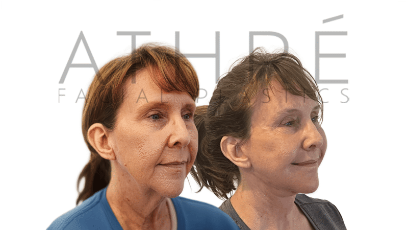 Before and after facial rejuvenation with lip lifts by Dr. Raghu Athré.