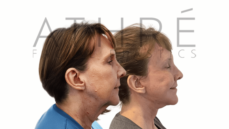 58 year old patient before and after facelift neck lift and lip lifts by Dr. Raghu Athré.