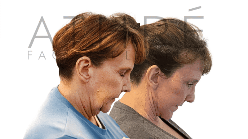Before and after 4D Facelift and lip lift surgery by Dr. Raghu Athré.