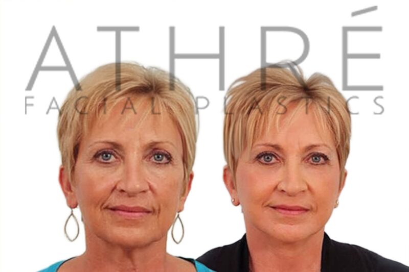 Before and after SMAS facelift and deep neck lift by Dr. Raghu Athré.