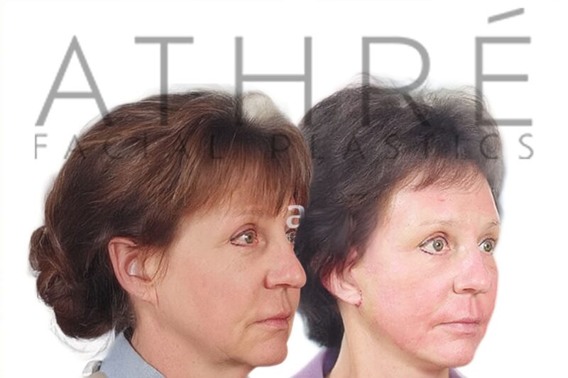 Before and after deep plane facelift and laser resurfacing by Dr. Raghu Athré in female patient.