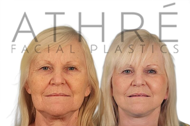 Before and after deep plane facelift and upper blepharoplasty by Dr. Raghu Athré in female patient.