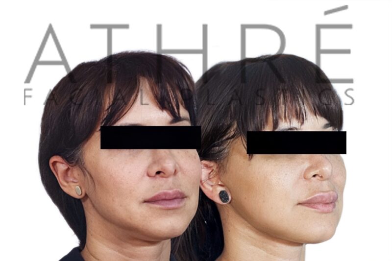 Female patient after MACS facelift and neck lift surgery by Dr. Raghu Athré.