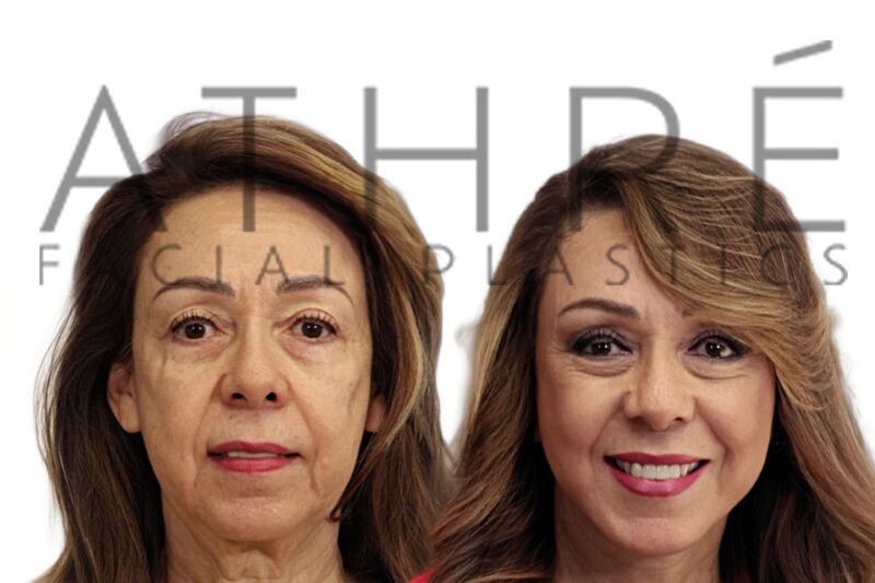 Before and after deep plane facelift and deep neck lift by Dr. Raghu Athré in female patient.