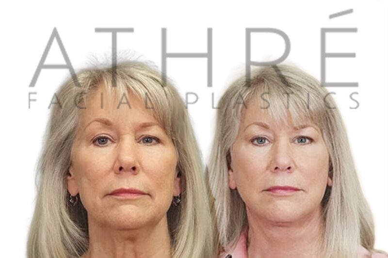 Before and after female deep plane facelift and neck lift results by Dr. Raghu Athré. Front view.