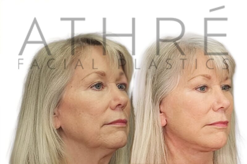 Female patient before and after deep plane facelift and deep neck lift by Dr. Raghu Athré