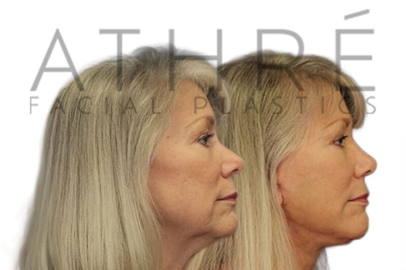 Before and after deep plane facelift and deep neck lift by Dr. Raghu Athré