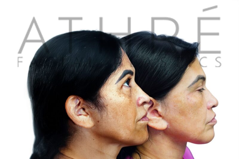 Before and after deep neck lift by Dr. Raghu Athré in female patient.