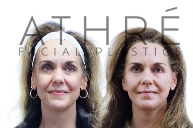 Deep neck lift with platysmaplasty and facial rejuvenation surgery by Dr. Raghu Athré.