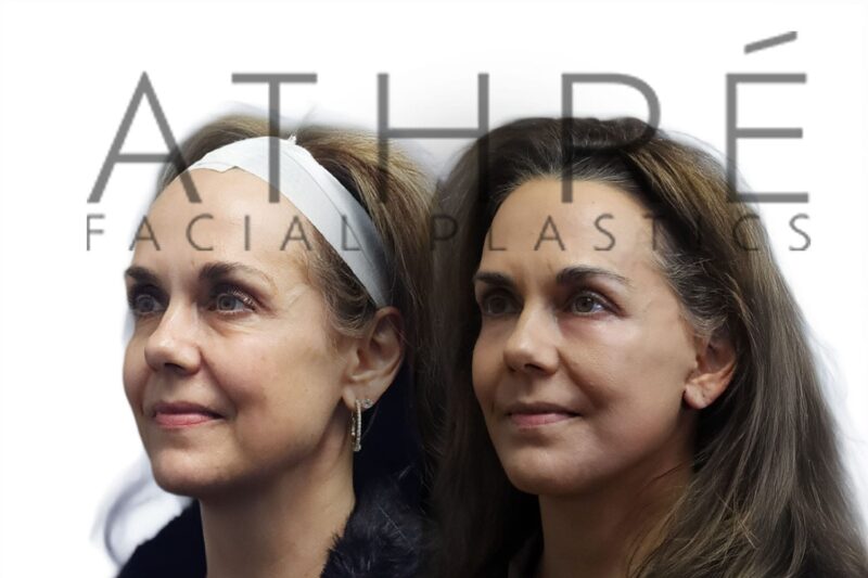 Female patient shown after neck contouring and MACS lift performed by Dr. Raghu Athré.