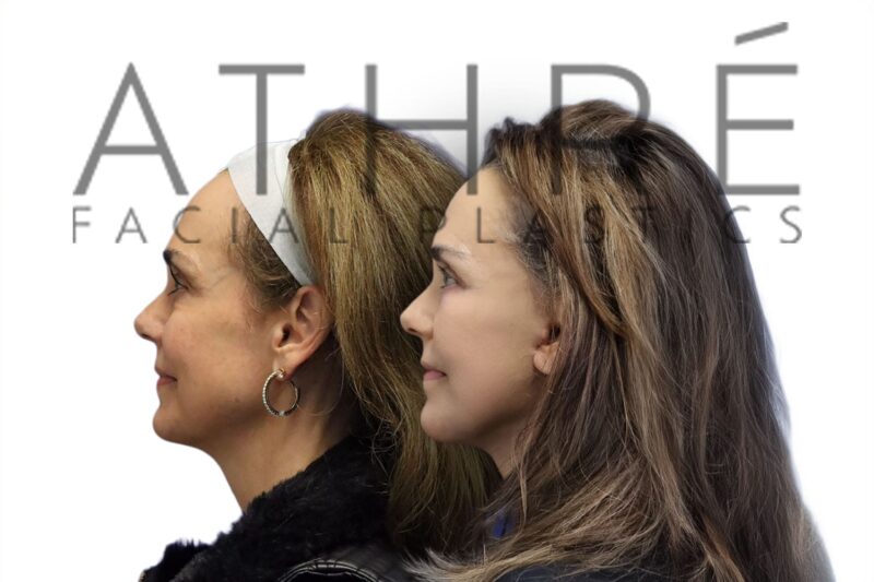 Before and after facial rejuvenation with deep neck lift and midface lift by Dr. Raghu Athré.