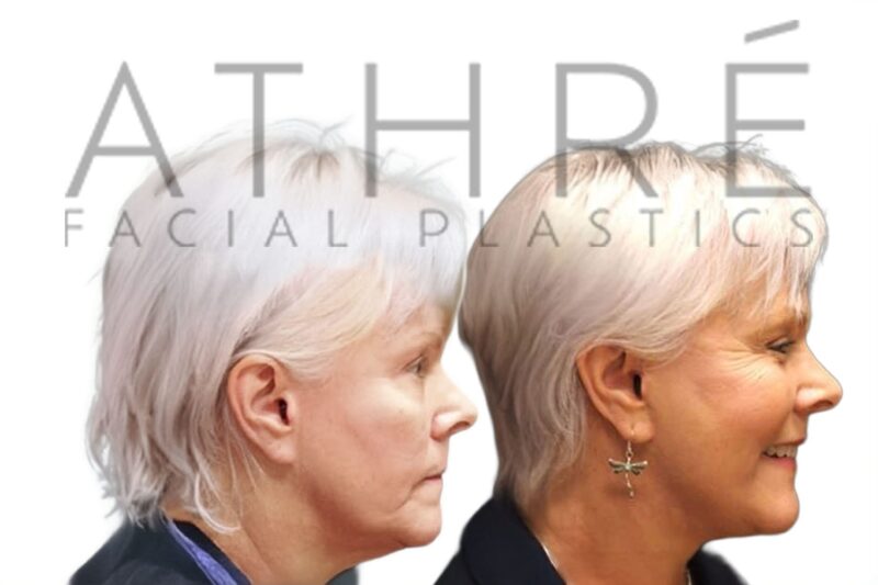 Before and after deep plane facelift and deep neck lift by Dr. Raghu Athré in female patient.