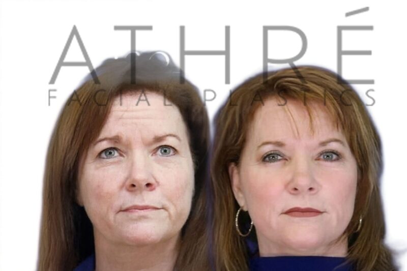 Before and after RT mini facelift and neck lift by Dr. Raghu Athré. Front view.
