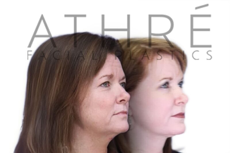 Female patient before and after RT mini facelift and neck lift by Dr. Raghu Athré.