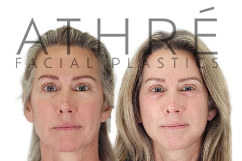 Female patient after MACS facelift and neck lift by Dr. Raghu Athré.