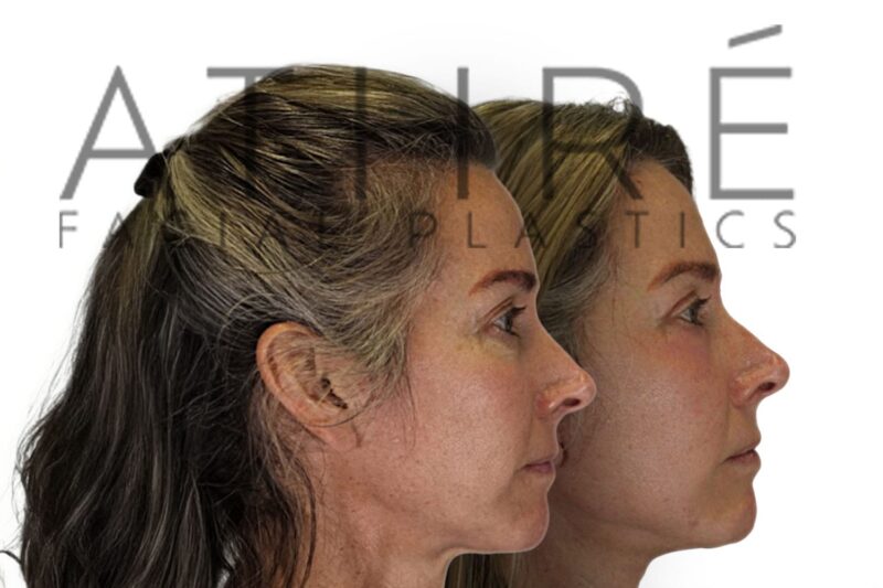 Before and after MACS lift and lower eyelid laser blepharoplasty by Dr. Raghu Athré in female patient.