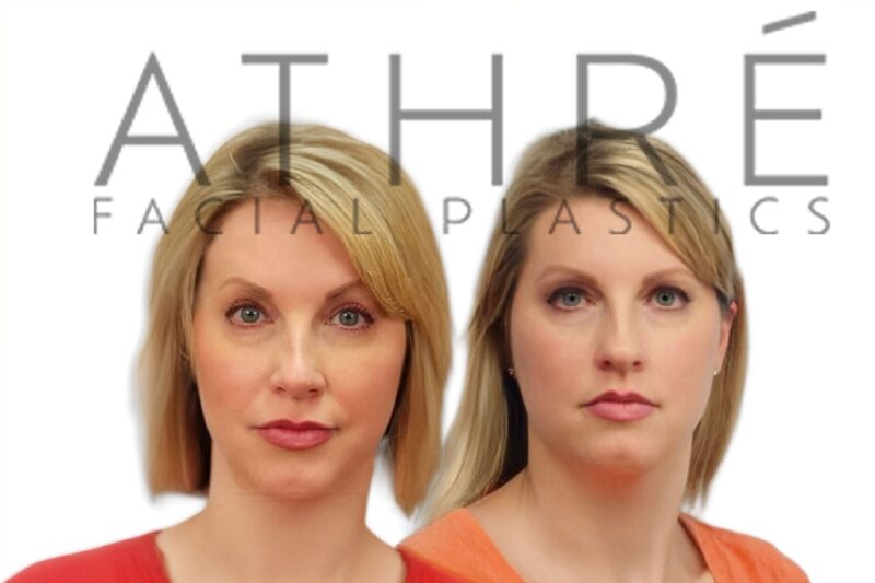 Before and after lower eyelid blepharoplasty and MACS midface lift by Dr. Raghu Athré in female patient.