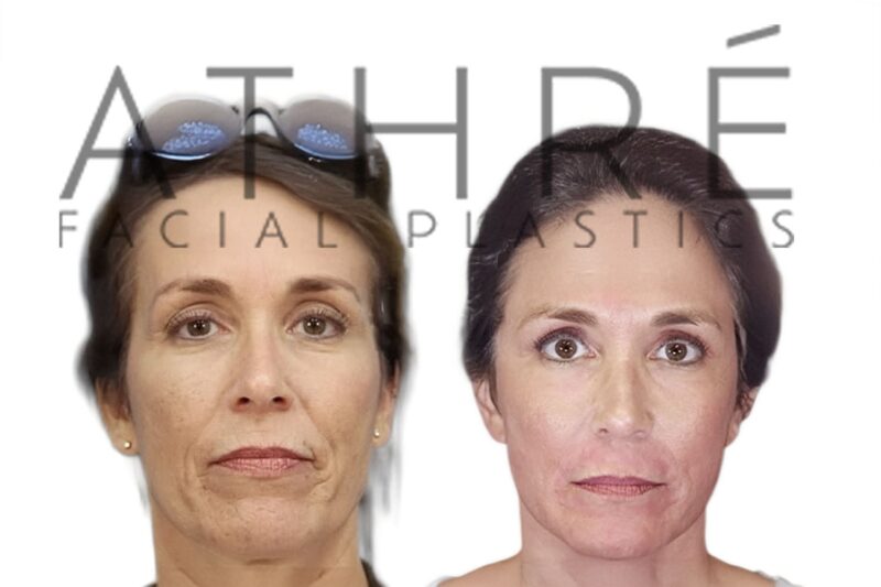 Before and after modified neck lift and MACS facelift by Dr. Raghu Athré in female patient.