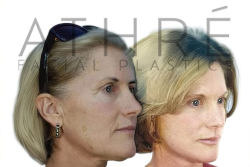 Before and after RT mini-facelift and neck lift by Dr. Raghu Athré in female patient.