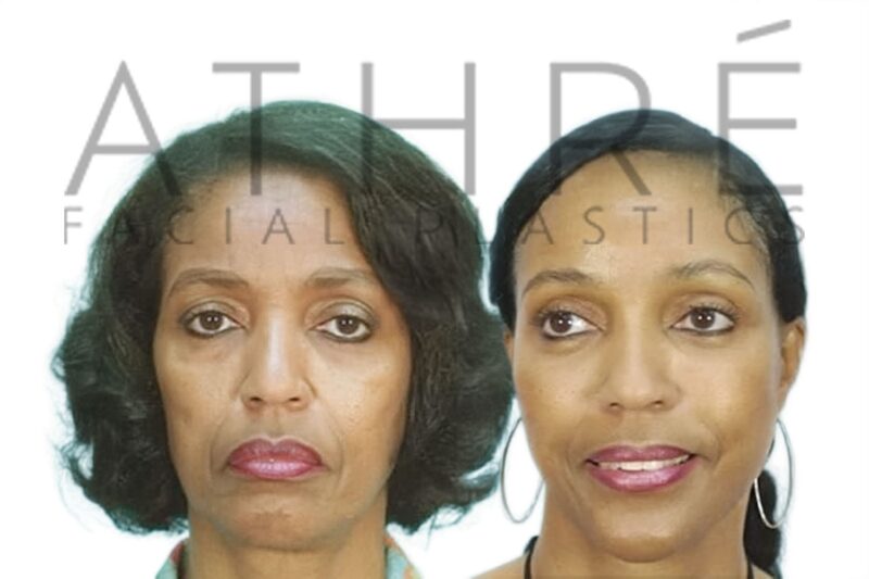 Before and after RT mini facelift and neck lift by Dr. Raghu Athré in female patient.