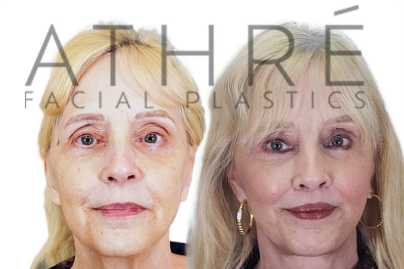 Before and after MACS facelift and neck lift by Dr. Raghu Athré in 65-year-old female patient.
