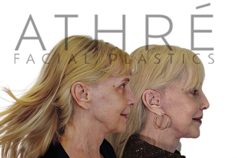 65-year-old woman before and after MACS facelift and neck lift performed by Dr. Raghu Athré.