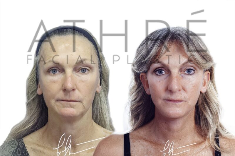 Before and after facial rejuvenation with MACS facelift and neck lift by Dr. Raghu Athré.