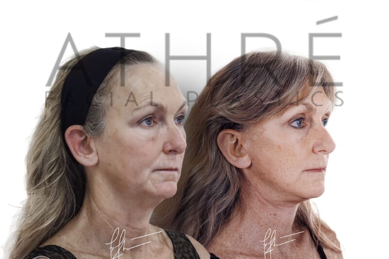 Female patient after MACS facelift and facial fat transfer by Dr. Raghu Athré.