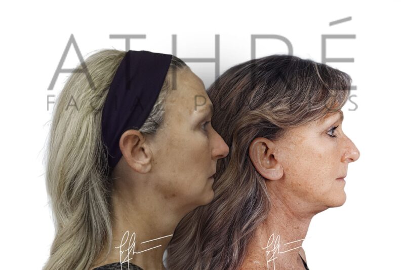 Before and after MACS facelift and neck lift by Dr. Raghu Athré in female patient.