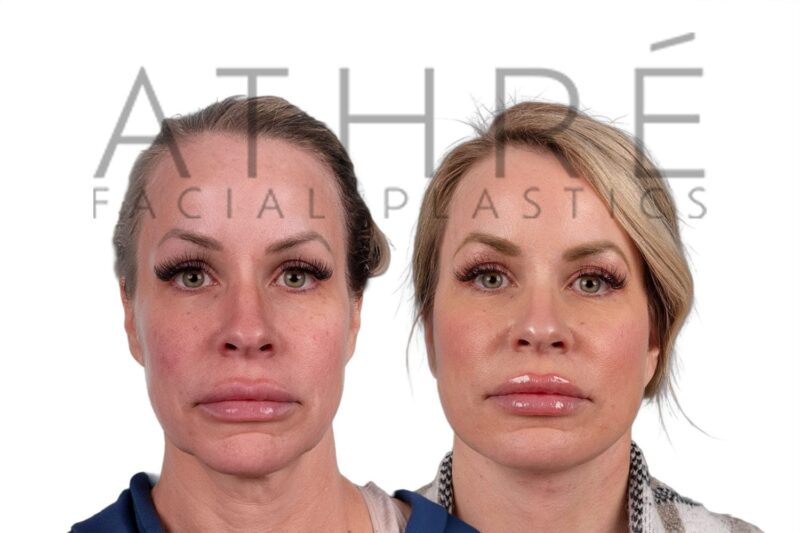 Facial rejuvenation surgery including facelift and neck lift by Dr. Raghu Athré.