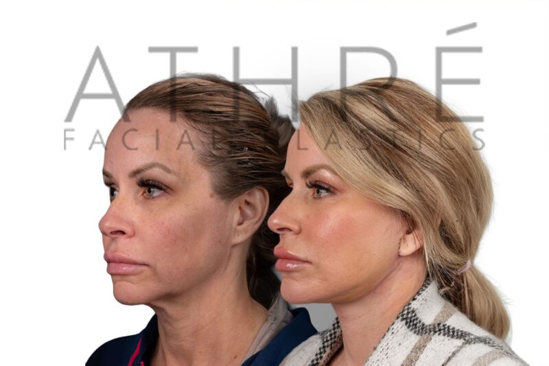 Female patient shown after deep plane facelift and fat grafting performed by Dr. Raghu Athré.