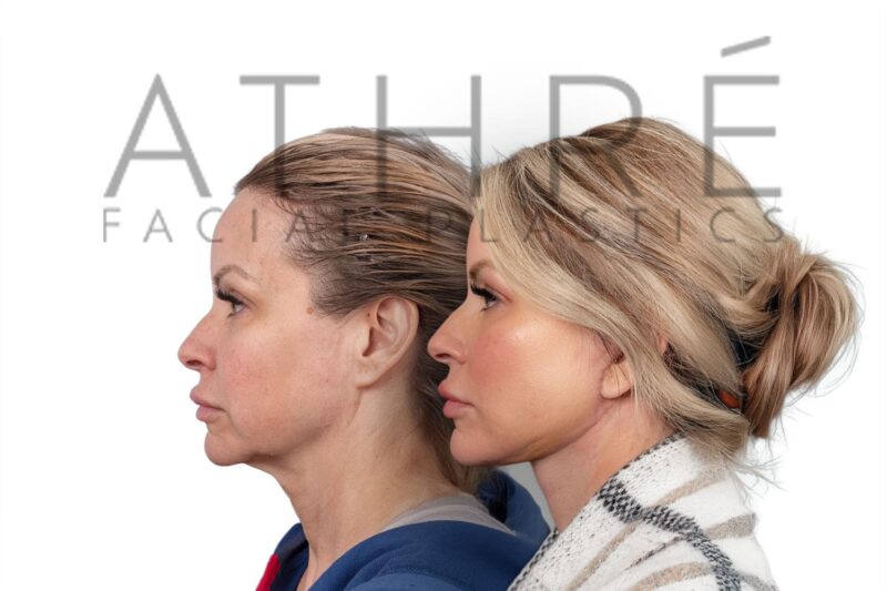 Before and after facial rejuvenation with deep plane face and neck lift by Dr. Raghu Athré.