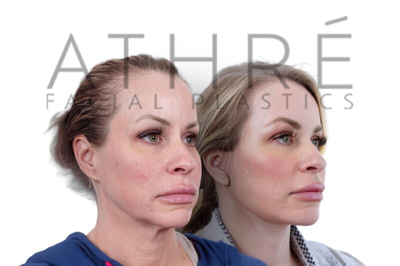 Female patient after facelift, neck lift, and facial fat transfer by Dr. Raghu Athré.