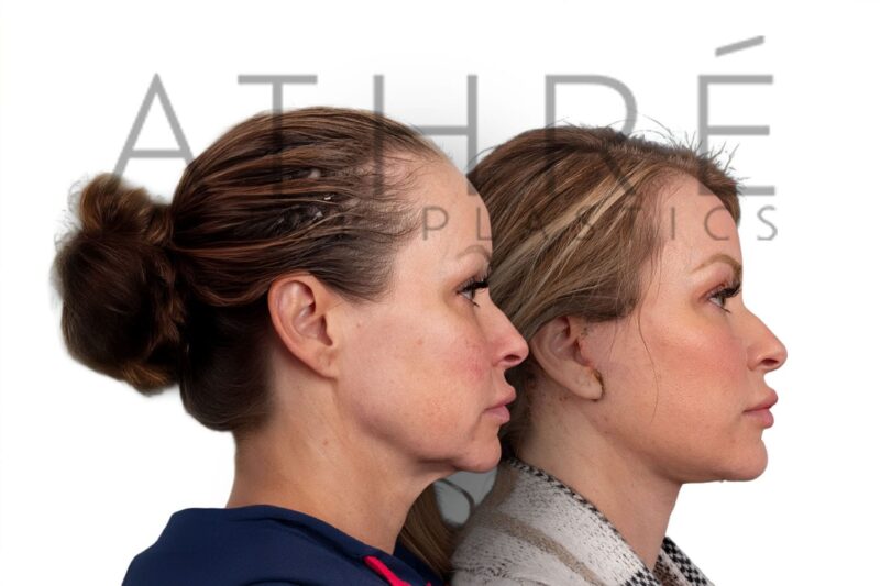 Before and after deep plane facelift and neck lift by Dr. Raghu Athré in female patient.