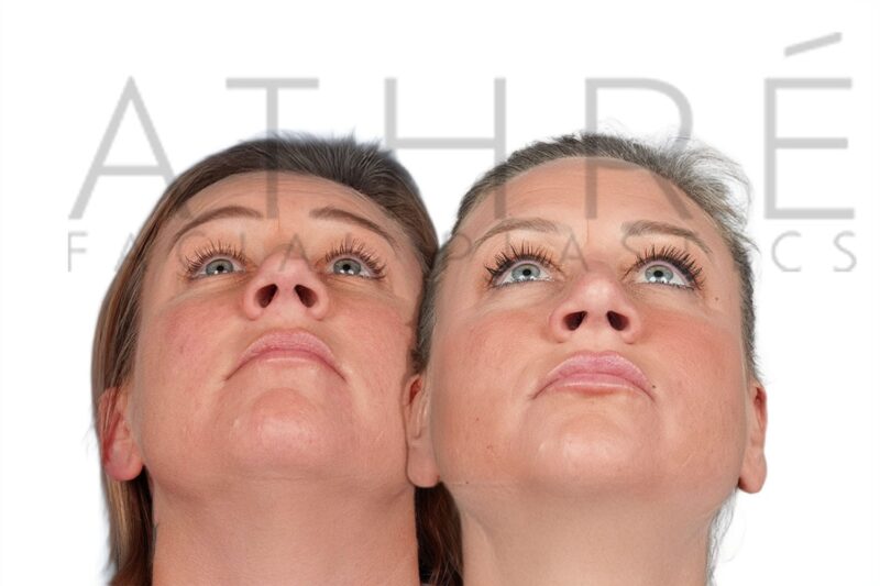 Before and after female primary rhinoplasty with refined feminine nasal profile and smoother bridge definition by Dr. Raghu Athré.