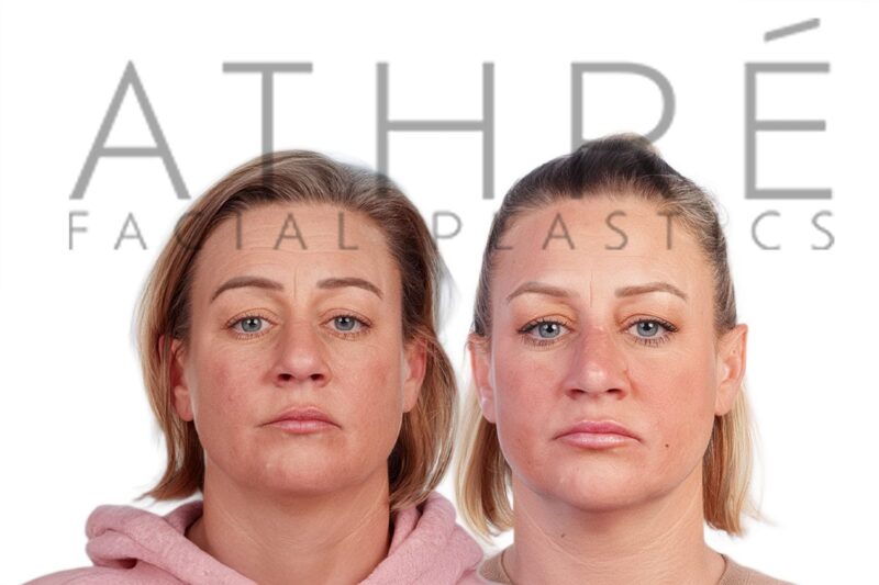 Before and after female primary ultrasonic rhinoplasty with enhanced tip refinement and smoother feminine nasal contour by Dr. Raghu Athré.