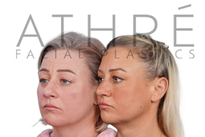 Before and after female primary rhinoplasty showing smoother bridge contour and refined feminine tip profile by Dr. Raghu Athré.